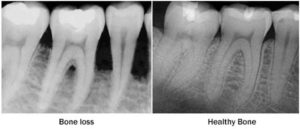 what bone loss looks like