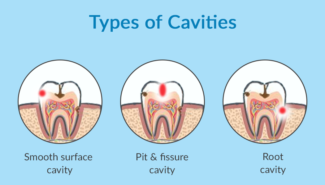 Types of Cavities