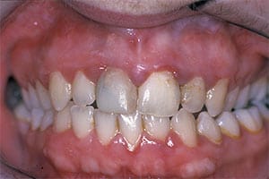 image showing gum disease